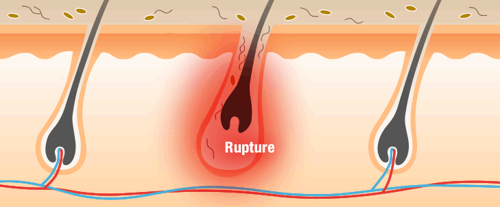 Rupture