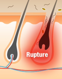  Rupture